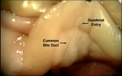 common bile duct cystic duct. 2010 common bile duct and