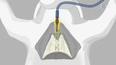 Cardiopulmonary Block Harvest from Rabbit: A Surgical Procedure to Retrieve Functional Heart-Lung Block from Rabbit Model