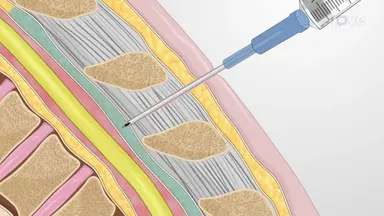 Intrathecal Placement of Lumbar Drain: A Technique to Withdraw Cerebrospinal Fluid from the Lumbar Spine in Porcine Model