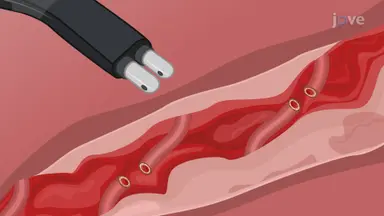 Bipolar Radiofrequency-Based Hemorrhage Arrest in Solid Organ Injury: A Technique to Arrest Bleeding in Porcine Model With Liver Injury Using Electrosurgery