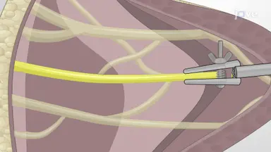 In Vivo Biomechanical Testing of Nerve: A Procedure for Biomechanical Analysis of Brachial Plexus Nerve Injury in a Neonatal Pig Model