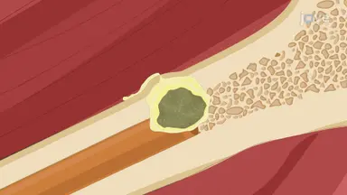Generating Rabbit Model of Bone Infection: A Technique of Inducing Chronic Infection by Injecting Bacteria Directly in Bone Marrow