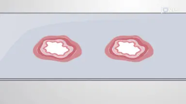 人直肠抽吸活检切片 S-100 蛋白的免疫组织化学染色
