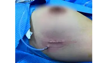 Single-port Non-liposuction Endoscopic Axillary Lymph Node Dissection in Breast Cancer Surgery