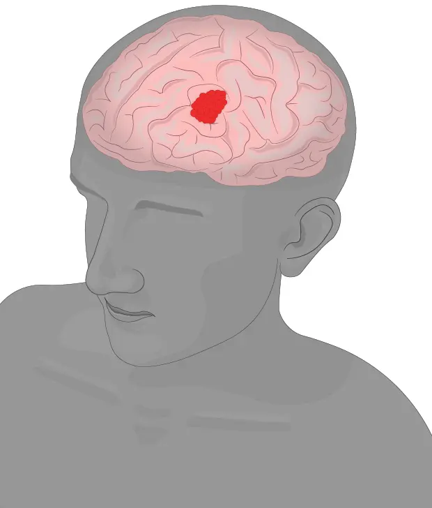 Cancers of the Nervous System