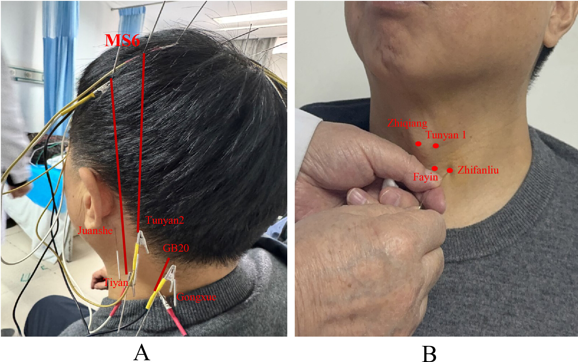 基于电针的脑电场疗法治疗单侧声带瘫痪伴上呼吸道感染后继发性吞咽困难