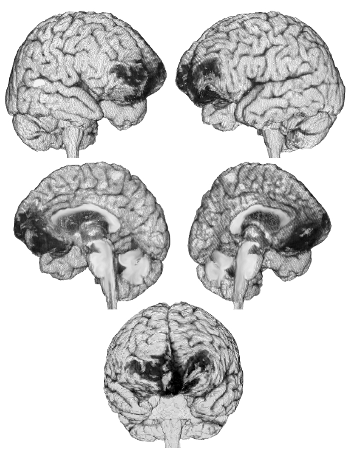 Brain structure analysis, MRI diagram; coronal, sagittal, axial views; neurological study.