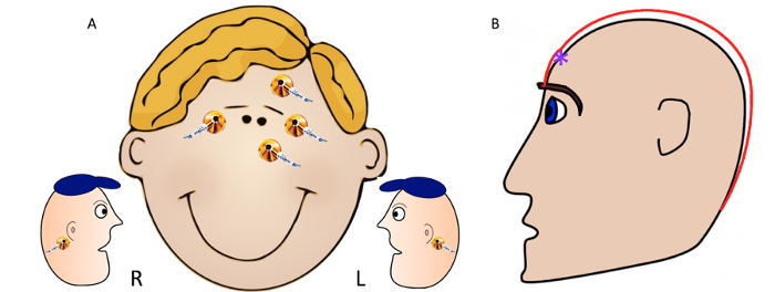 Facial nerve paralysis diagram; side view, showing nerve pathways and muscle control indicators.