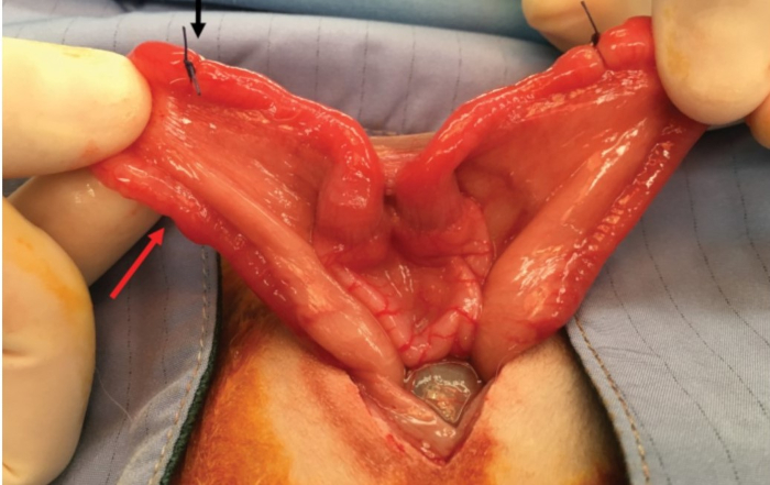 figure-results-1 Surgical anatomy of inguinal region, cadaver dissection, exposure of muscle and fascia layers.