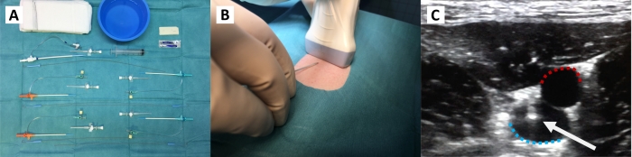 Central venous catheter procedure: setup, needle insertion, ultrasound-guided placement (diagram).