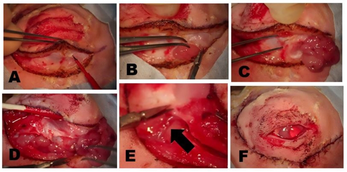 Surgical procedure sequence, scalp incisions, tumor removal, step-by-step medical technique.