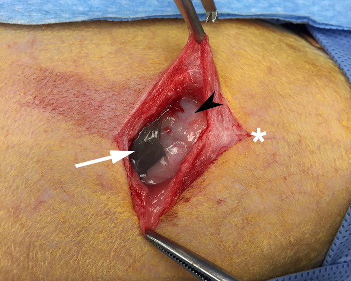 Surgical procedure showing intraoperative findings of encapsulated hematoma in soft tissue.