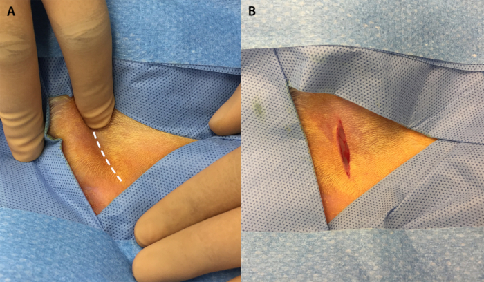 Surgical incision site marking and post-incision on skin; illustrates incision planning and execution.