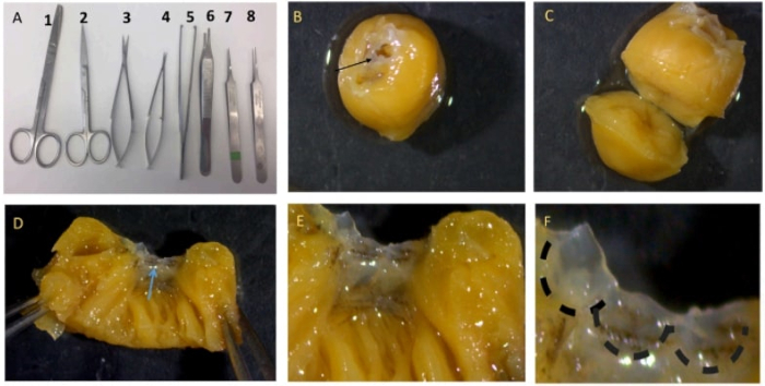 Surgical dissection series; tools shown; orange tissue under manipulation; close-up examination.