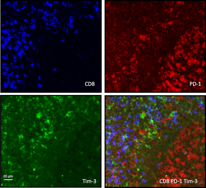 Immunofluorescence markers CD8, PD-1, Tim-3 in tissue sections, microscopy analysis, overlay comparison.