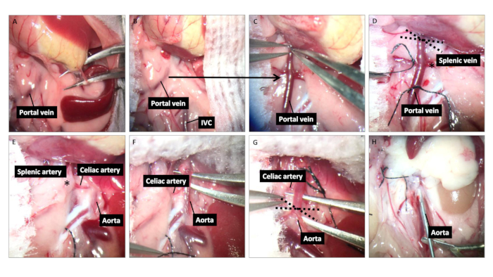 figure-results-1 Surgical procedure diagram, vascular dissection of portal vein, splenic artery, and aorta.