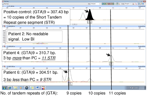 Short Tandem Repeat analysis results; electrophoresis graph comparing patient DNA fragment sizes.