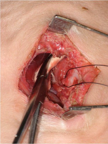 figure-protocol-3 Procedura chirurgiczna, operacja tkanki ludzkiej, użycie kleszczyków, wizualizacja anatomiczna, szczegółowa dyssekcja.