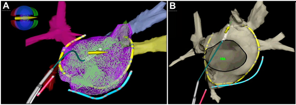 Cardiac anatomy 3D visualization; heart model highlighting mitral valve; comparative structure analysis.