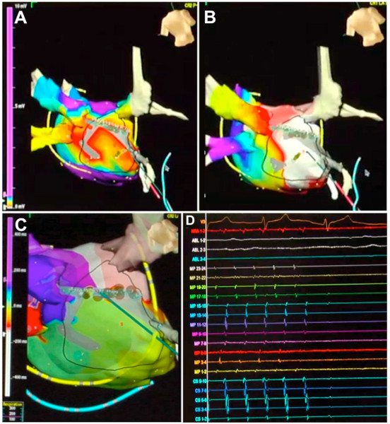Cardiac mapping; electrophysiology study; 3D heart models and electrocardiogram (ECG) traces.