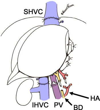 figure-results-9 Schemat anatomii naczyniowej wątroby przedstawiający SHVC, IHVC, PV, HA i BD na potrzeby edukacji chirurgicznej.