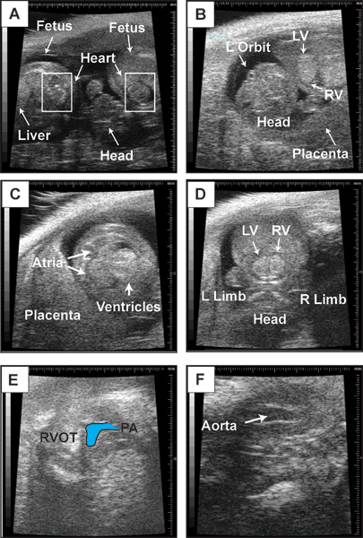 figure-protocol-2 Ultrasound images of fetal development, labeled anatomy: heart, ventricles, aorta, placenta.
