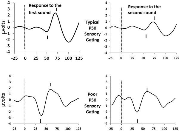 Electrophysiology graphs showing typical and poor P50 sensory gating responses to auditory stimuli.