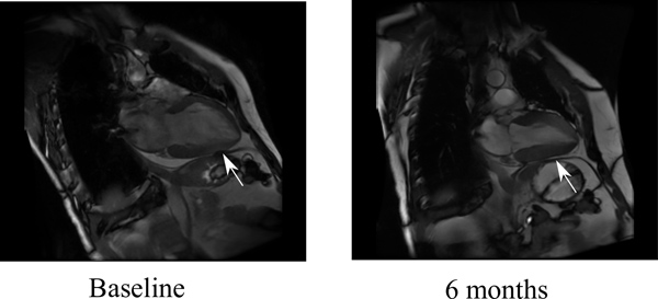 figure-results-1 Cardiac MRI comparison; baseline vs 6 months, heart muscle changes, diagnostic imaging analysis.