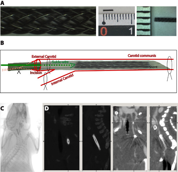 Carotid stent insertion diagram and X-ray imaging; guidewire positioning, vascular access in research.