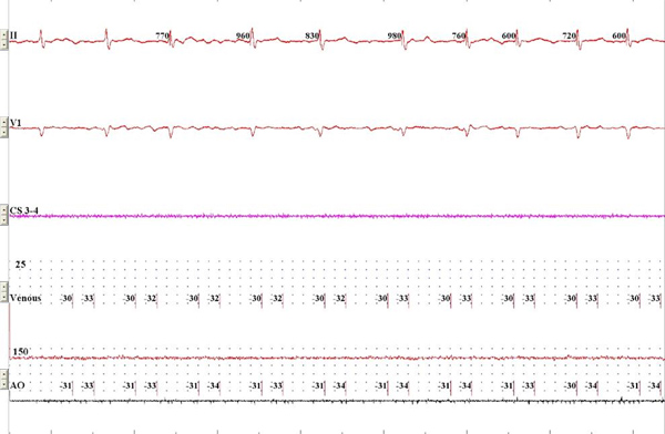 ECG waveform analysis, diagram, heart monitoring data, multi-lead electrocardiogram, arrhythmia detection.