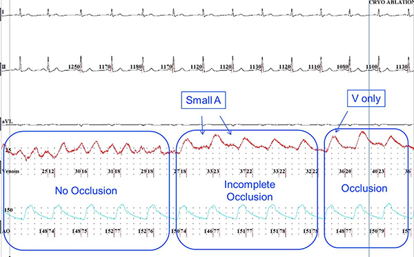 Electrophysiology study diagram showing heart occlusion patterns; ECG waveform analysis.