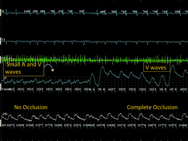 Hemodynamic waveforms chart; venous pressure changes; small and V waves; occlusion study result.