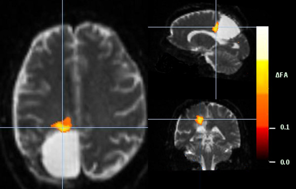 Brain fMRI activation map, statistical result, highlighting regional activity with color scale ΔF contrast.