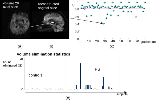 Video: Diffusion Tensor Magnetic Resonance Imaging in the Analysis of ...