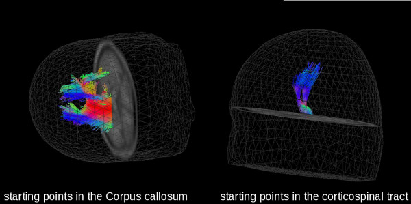 Diffusion tractography diagrams of Corpus callosum and corticospinal tract with neural pathways.