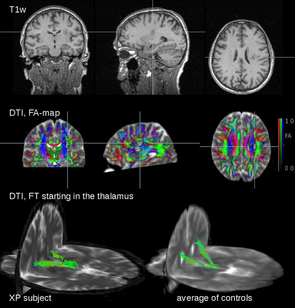 Brain MRI and DTI FA maps showing thalamus fiber tracking; comparative analysis in XP and controls.