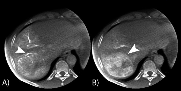 figure-results-2 CT scan liver, axial view, arrow indicates lesion comparison, medical imaging analysis.