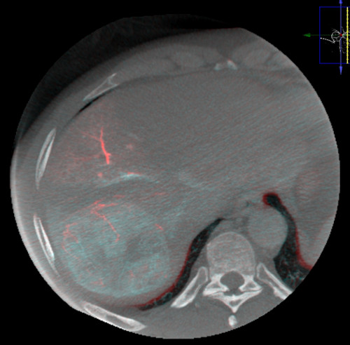figure-results-3 CT scan; liver cross-section; diagnostic imaging; includes vascular structures; anatomy study.
