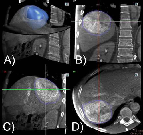 figure-results-4 CT scan series depicting 3D liver tumor segmentation; medical imaging, diagnostic evaluation.