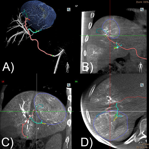 figure-results-5 Hepatic arterial anatomy in CT angiography; liver perfusion; 3D rendering, vascular mapping.