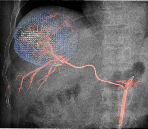 figure-results-6 Angiography diagram showing blood vessels in the abdomen with visualization mesh for analysis.