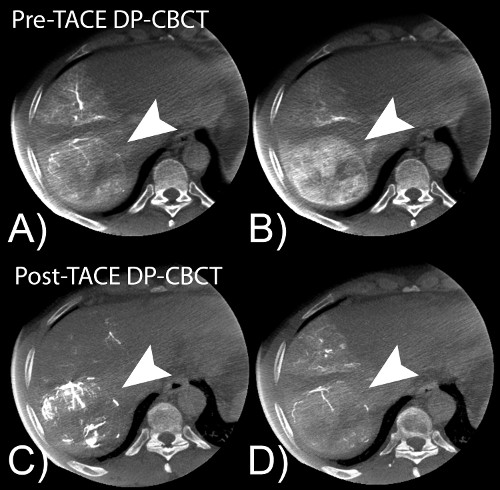 figure-results-7 TACE DP-CBCT liver scans, pre/post-treatment. Medical imaging analysis, tumor visualization.