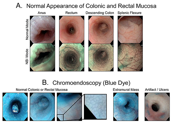 figure-results-3 Colonic mucosa appearance; endoscopy vs chromoendoscopy, normal and blue dye modes, comparison.