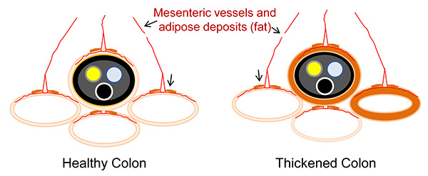 figure-results-4 Healthy vs. thickened colon diagram showing mesenteric vessels and adipose deposits comparison.