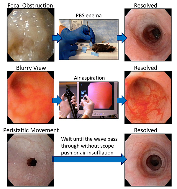 figure-results-5 Colonoscopy process diagram; fecal obstruction resolutions via PBS enema, air aspiration methods.