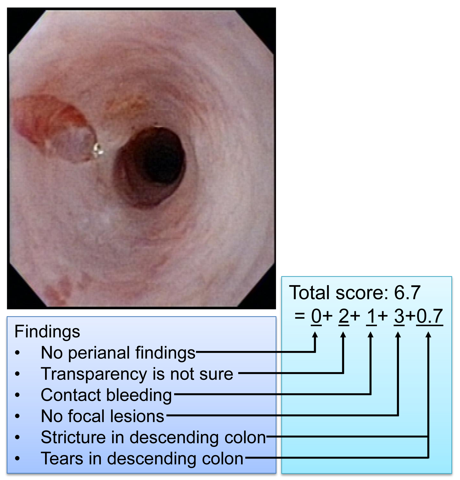 figure-results-11 Colonoscopy findings diagram; notes on contact bleeding, colon stricture, and scoring system.