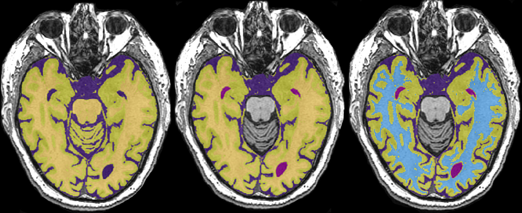 figure-results-7 Brain MRI segmentation diagram showing tissue differentiation in coronal slices.