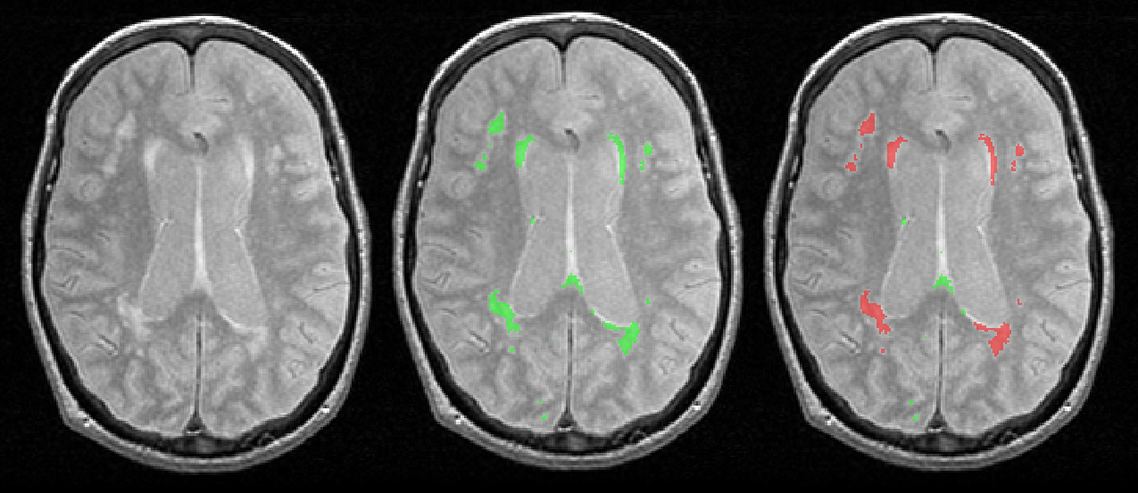 figure-results-10 Brain MRI scans showing lesion detection analysis with color-coded markers, comparison diagram.