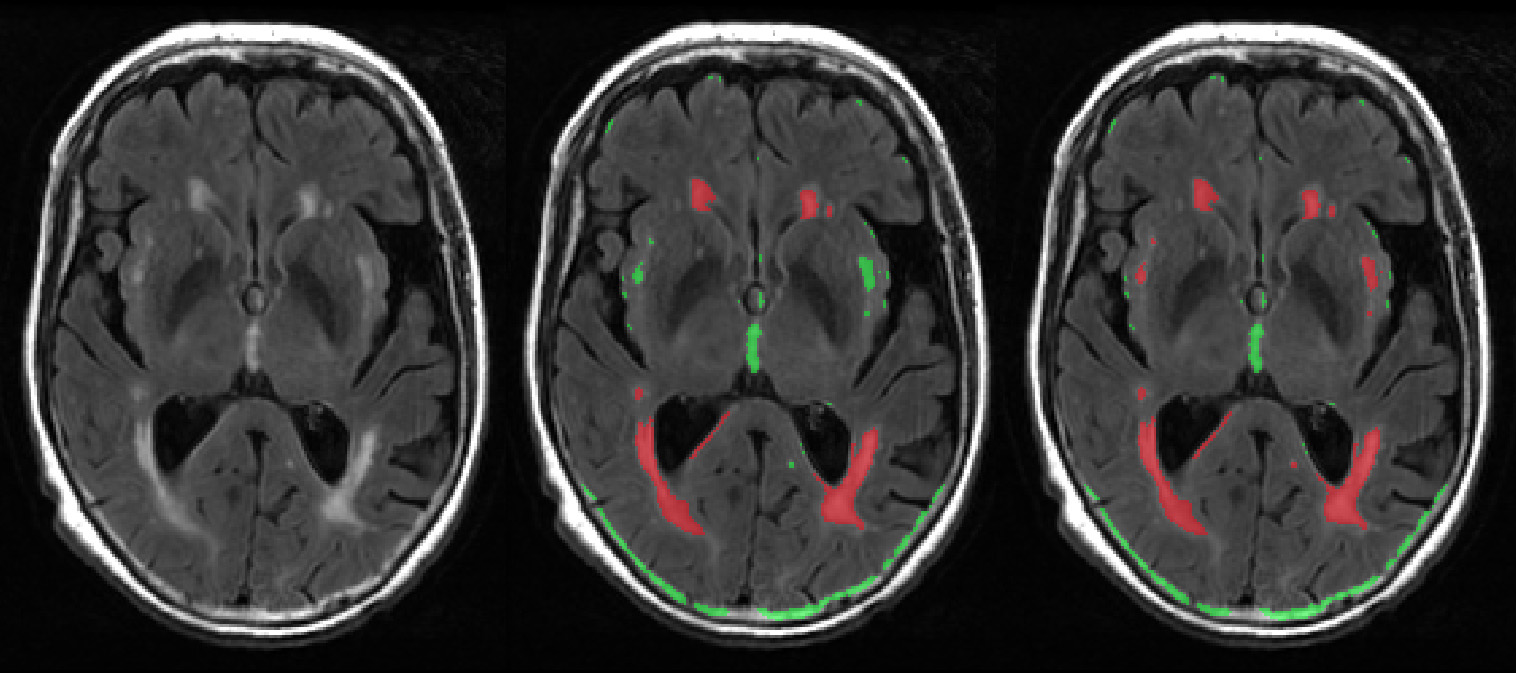 figure-results-11 MRI brain scan showing lesion mapping, axial view, with highlighted regions in red and green.