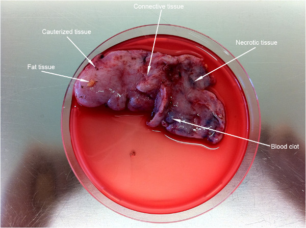 Pathology analysis, labeled tissue types in petri dish, necrosis, blood clot, connective tissue study.